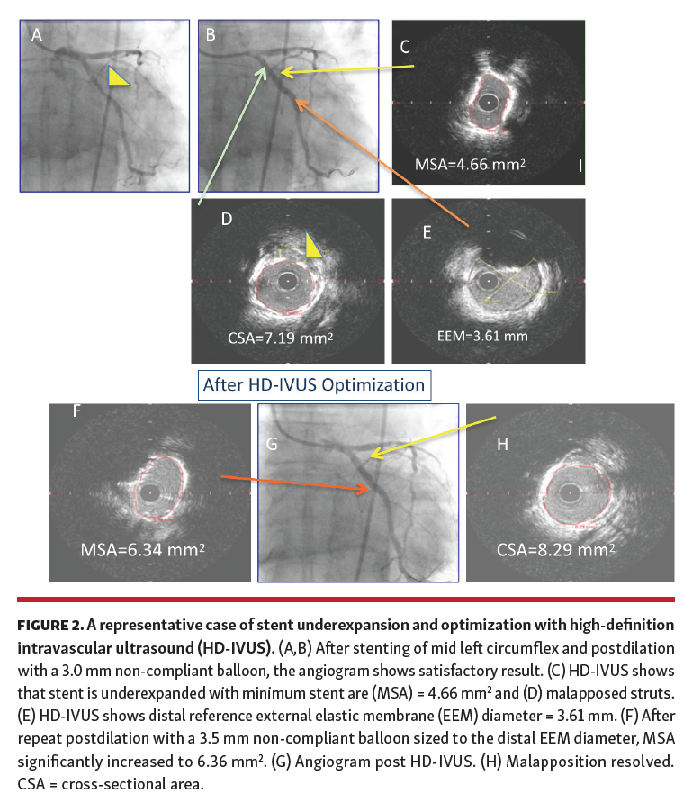 A New Method to Optimize Stent Deployment by HighDefinition